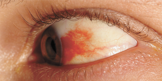 retinopatia diabetica occhio