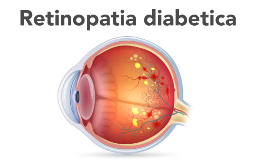 occhio con retinopatia diabetica