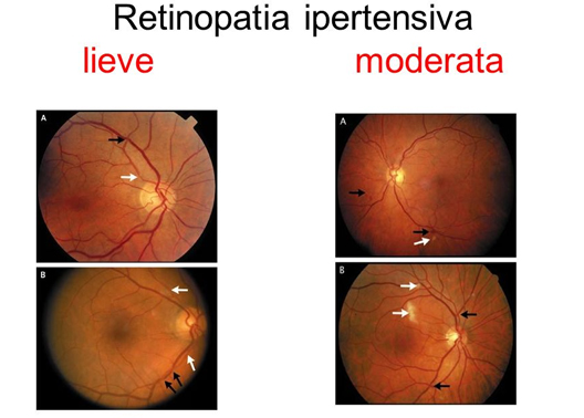 retinopatia ipertensiva lieve e moderata
