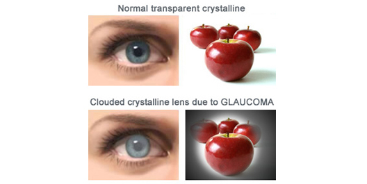 visione con glaucoma